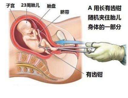 药物流产半个月有血块，原因、处理与预防