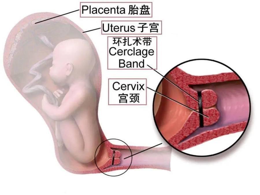 孕五个月小腹坠胀，原因、管理与注意事项